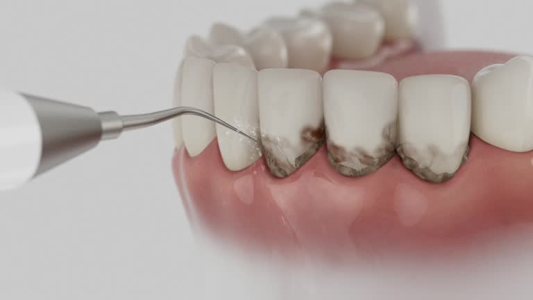 Reliable Dental Implants contractor in Appleton City, MO by Smile Center Dentistry